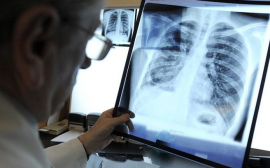 Россияне стали реже умирать от туберкулеза
